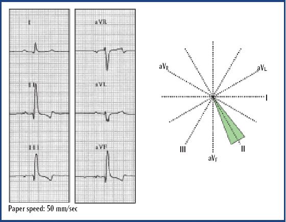 Skills Laboratory: How to determine and interpret the mean electrical axis