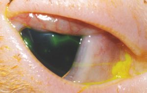 Herpes-conjunctivitis-and-ulcer.jpeg