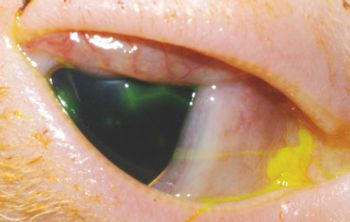 Herpes-conjunctivitis-and-ulcer.jpeg