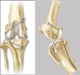 Surgery STAT: Tightrope CCL for treating canine cranial cruciate deficiency