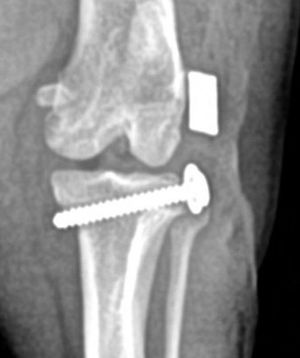 The washered-anchor technique