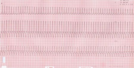 what causes sinus arrhythmia in dogs