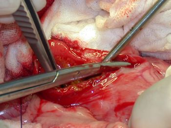 Pyloroplasty_fig2b_450-816231-1404220537500.jpg