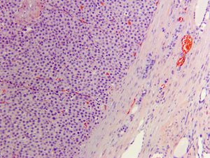 veterinary_thyroid_carcinoma_Figure_8_450.jpg
