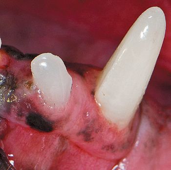 1left mandibular incisor-754722-1384165120440.jpg