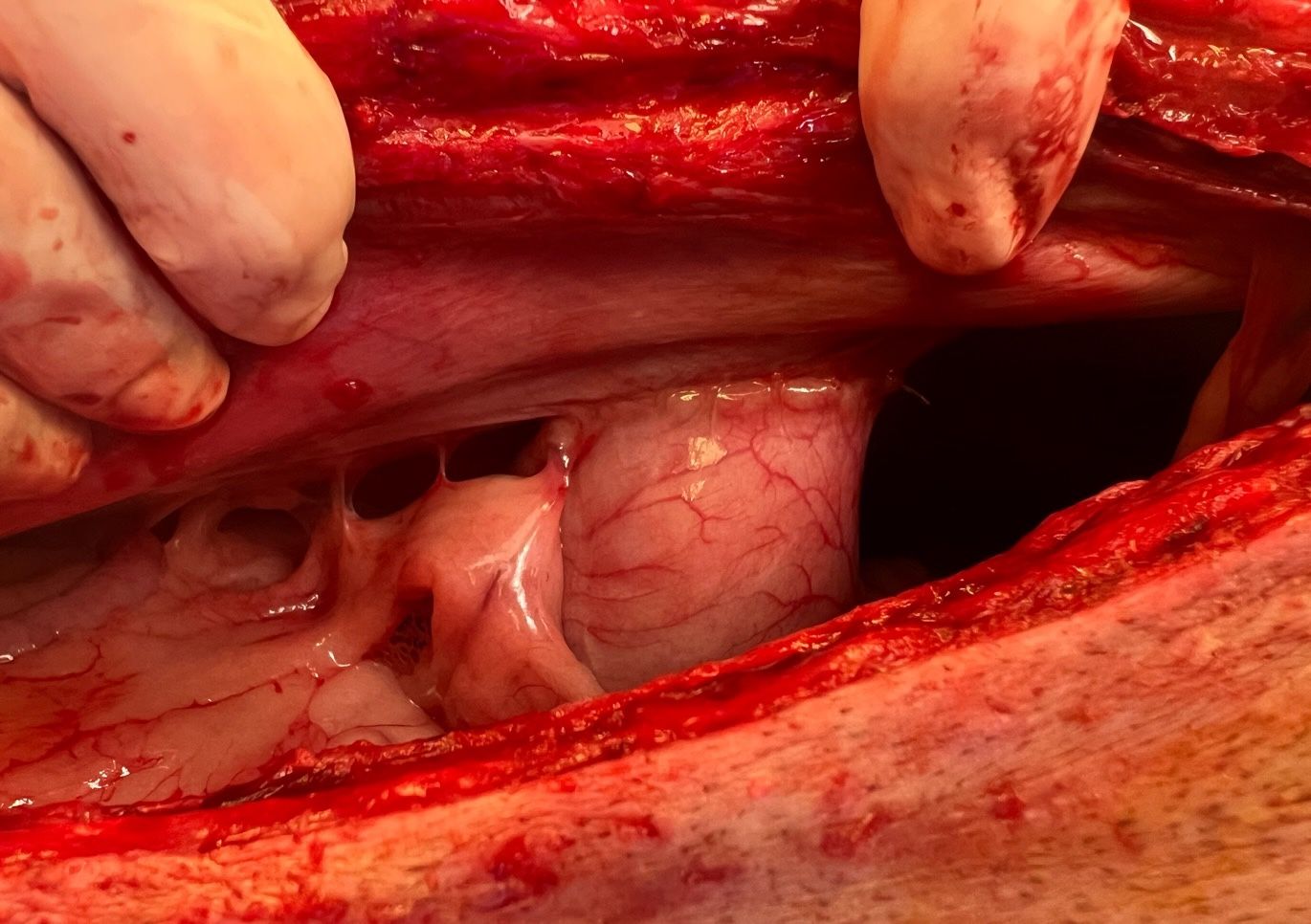 Healed incisional gastropexy