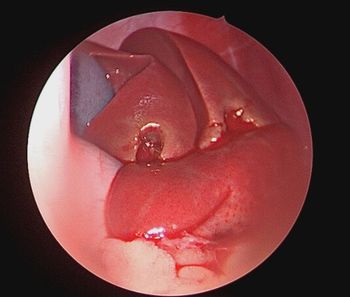 Liver biopsy