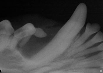 Greenfield_dentigerous_cyst_450.jpg