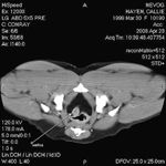 Diagnosis, treatment of transitional cell carcinoma (TCC) in dogs