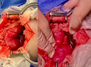 The guillotine technique