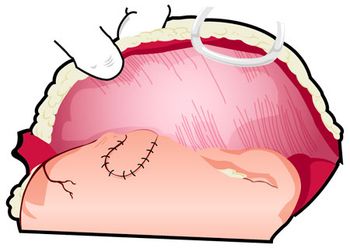 Step6_Gastropexy_450-791743-1384155963490.jpg