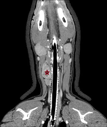 veterinary_thyroid_carcinoma_Figure_7b_450.jpg