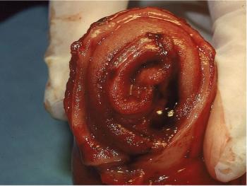 Surgical image of intussusception 