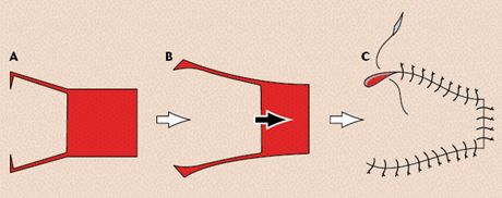 Wound repair techniques: Single pedicle advancement flaps