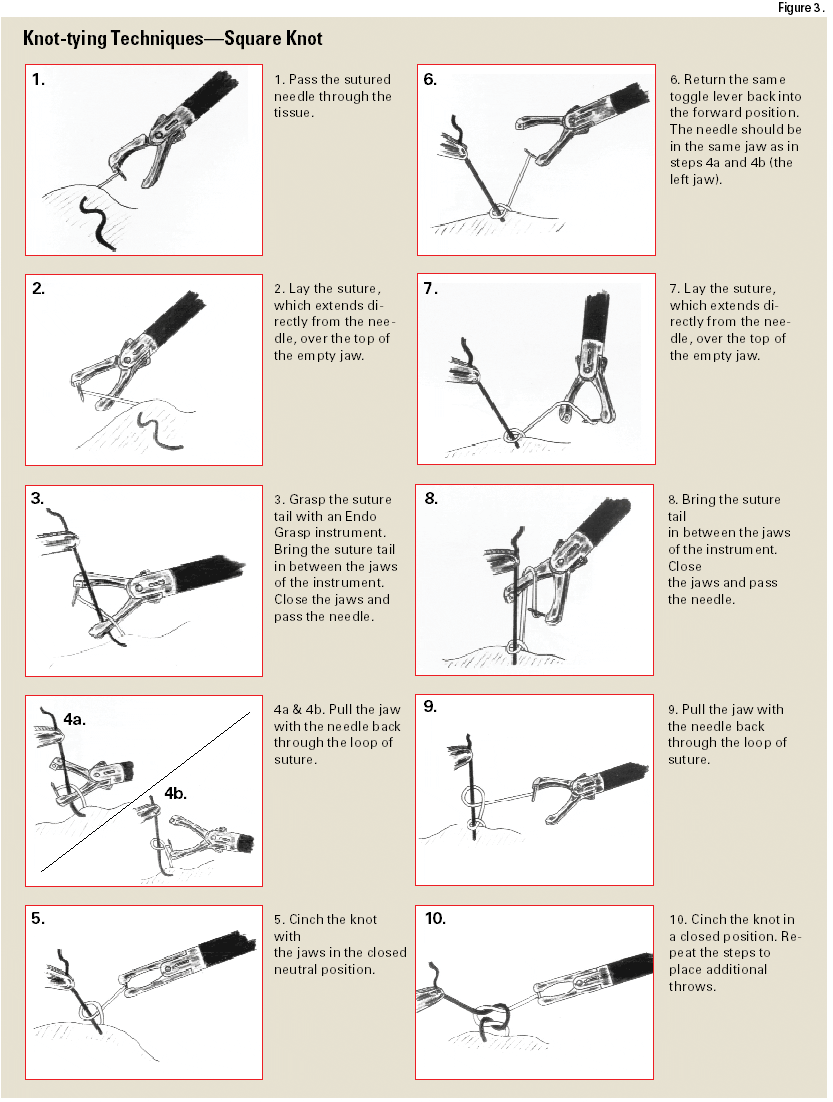 Minimally invasive knot-tying. (A) The knot-typing procedure starts