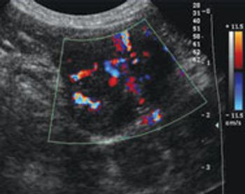 ZwingFig-2-thyroid-carcinom_t-581074-1384522658845.jpg