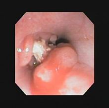 Pre-endoscopy 