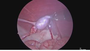 laparoscopic cryptorchiectomy