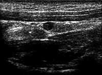 how is hyperparathyroidism treated in dogs