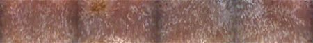 Alicam_Dilated-lacteals_450.jpg