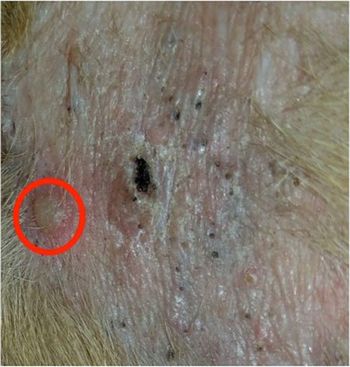 Biopsy1_circled_450.jpg