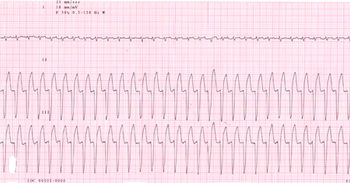 Whit_ventricular_tachcardia_450.jpg