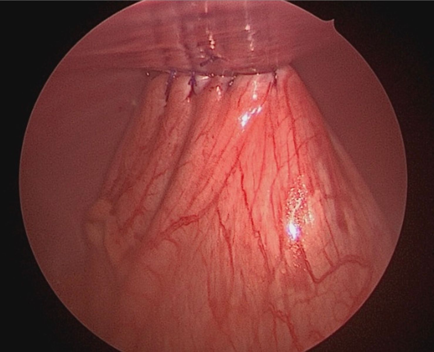 Total laparoscopic gastropexy