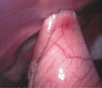 Picture3.Laparoscopic view of completed gastropexy-586888-1384520915337.jpg