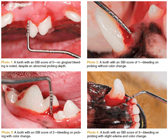 periodontal-probing-stop-when-you-see-red