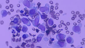 abnormal_lymphocytes_body.jpg