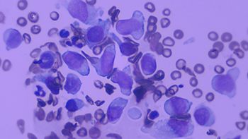 abnormal_lymphocytes_body.jpg