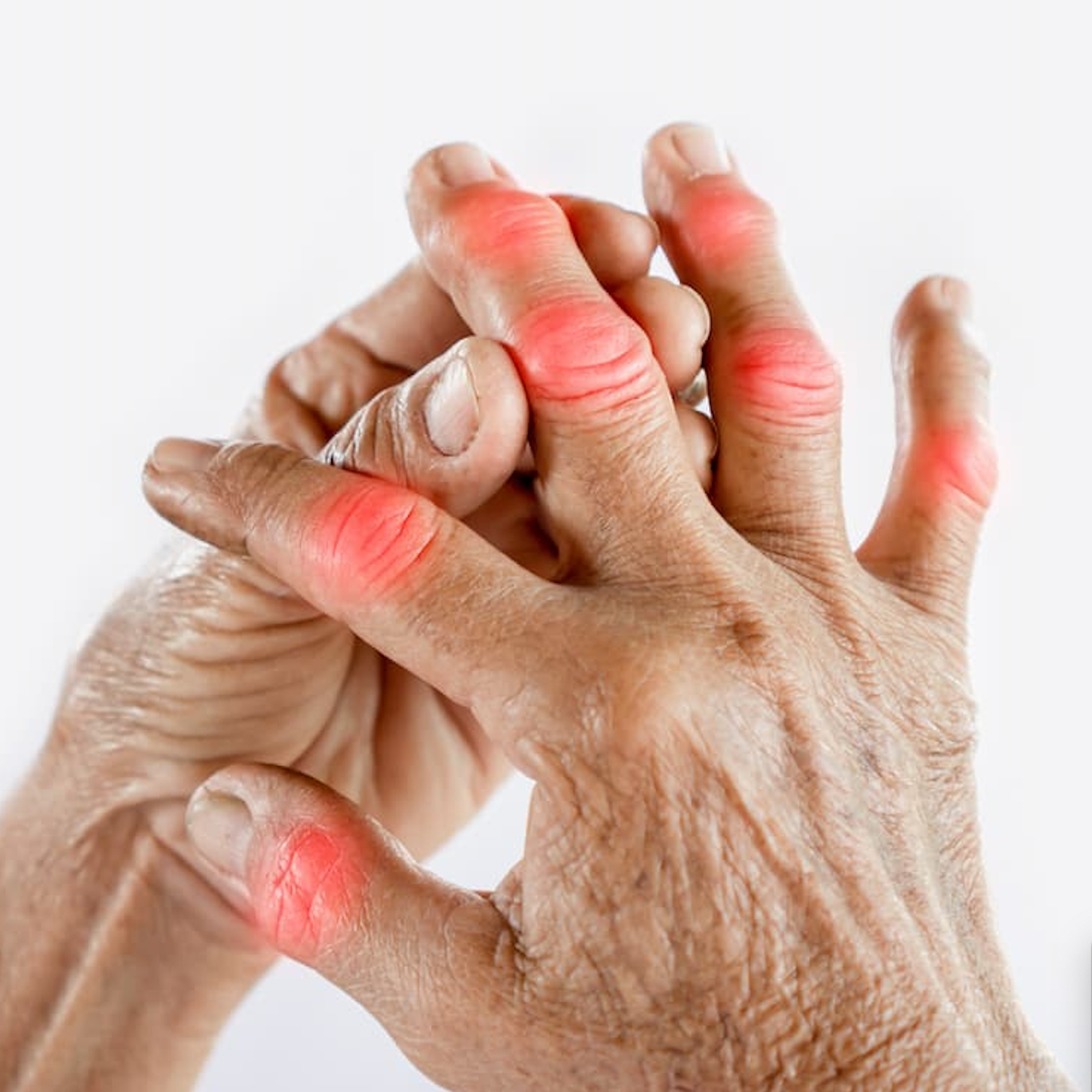 Real Patient Stories: How Others Are Managing Uncontrolled Gout 
