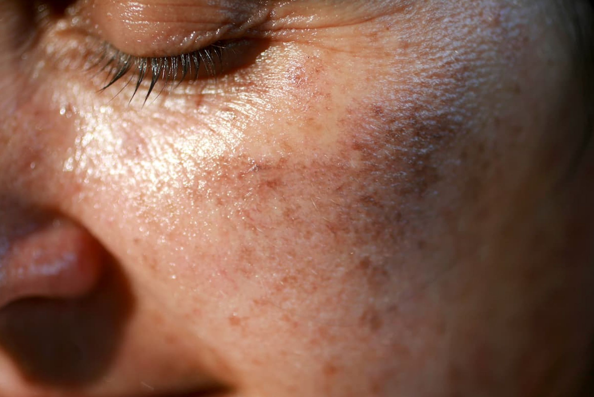What Sun Damage Actually Looks Like and When to See a Dermatologist