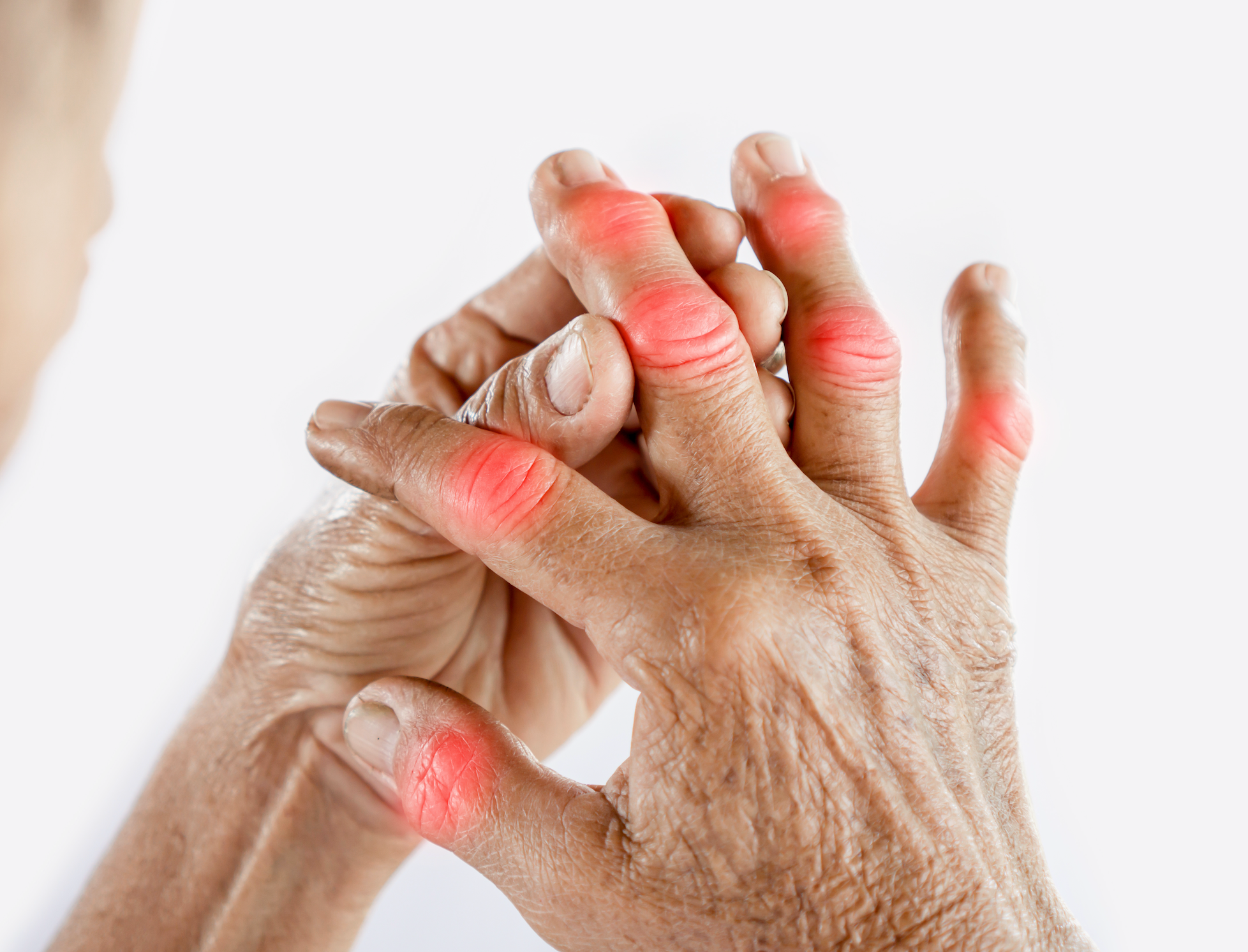 The Educated Patient Podcast: Understanding Rheumatoid Arthritis