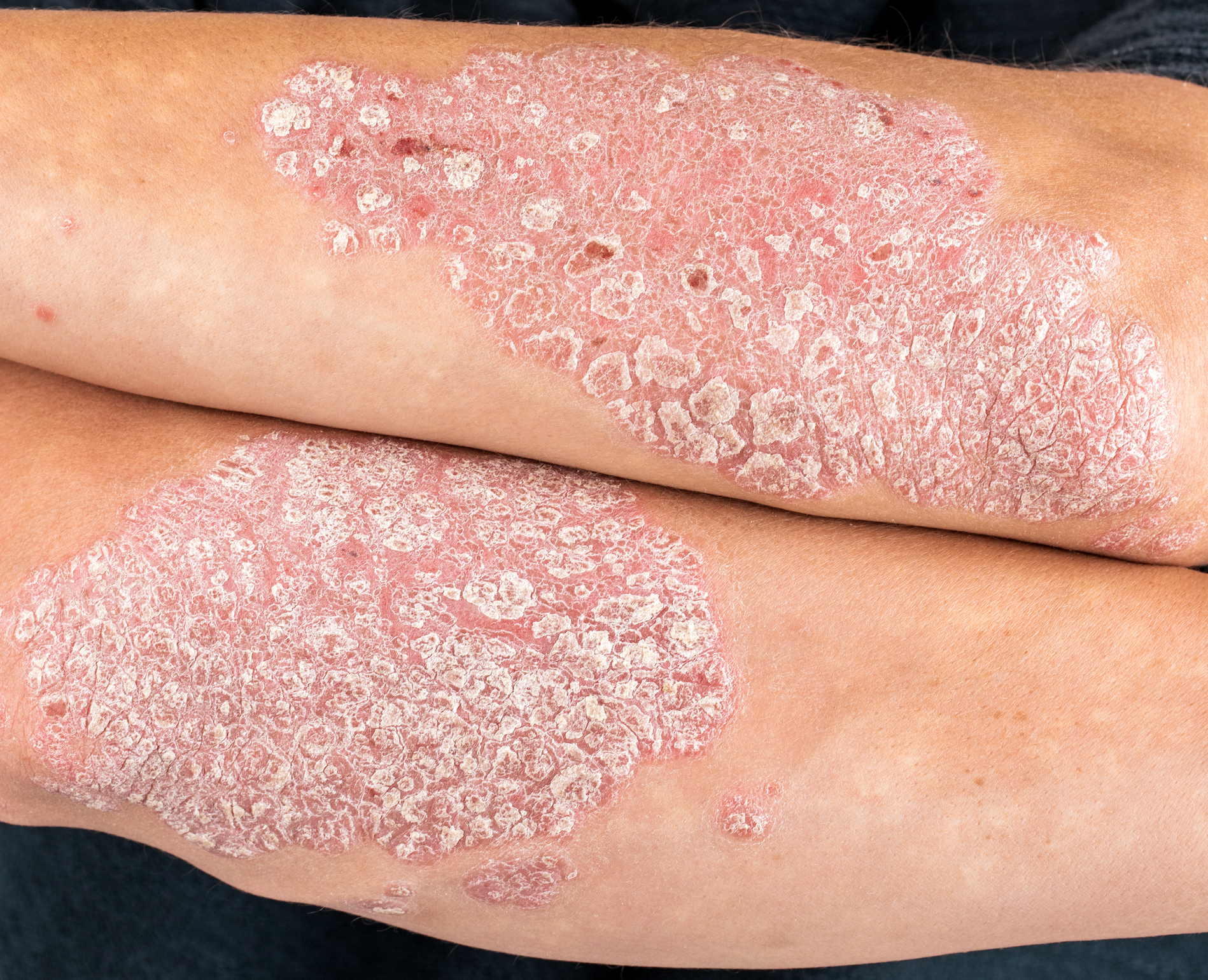 Test Your Psoriasis Knowledge This Psoriasis Action Month