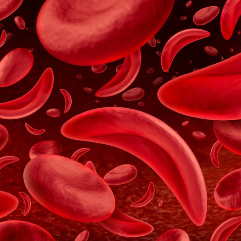 Sickle Cell Science Quiz: What Every Patient Should Know