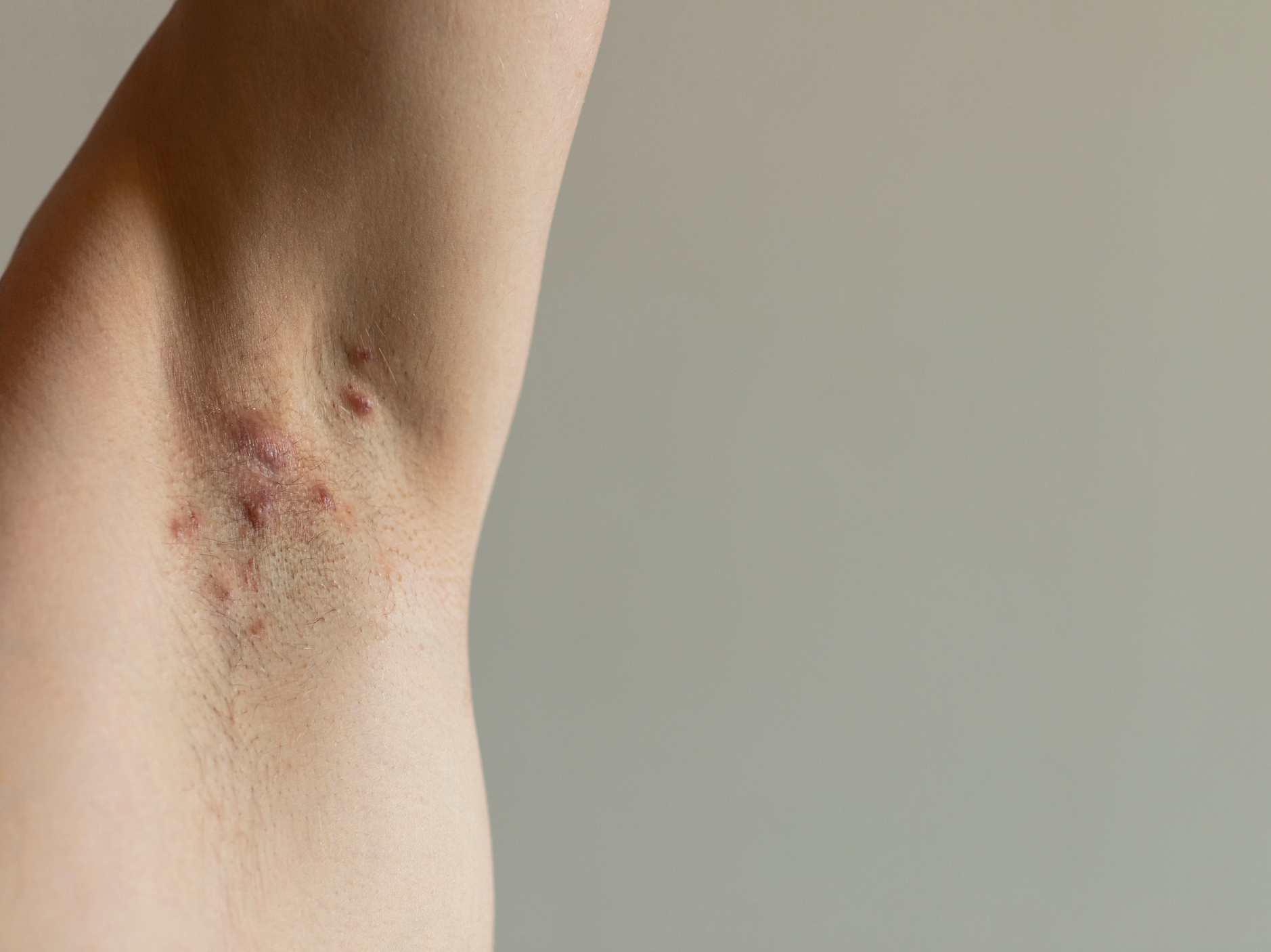 Hidradenitis Suppurativa