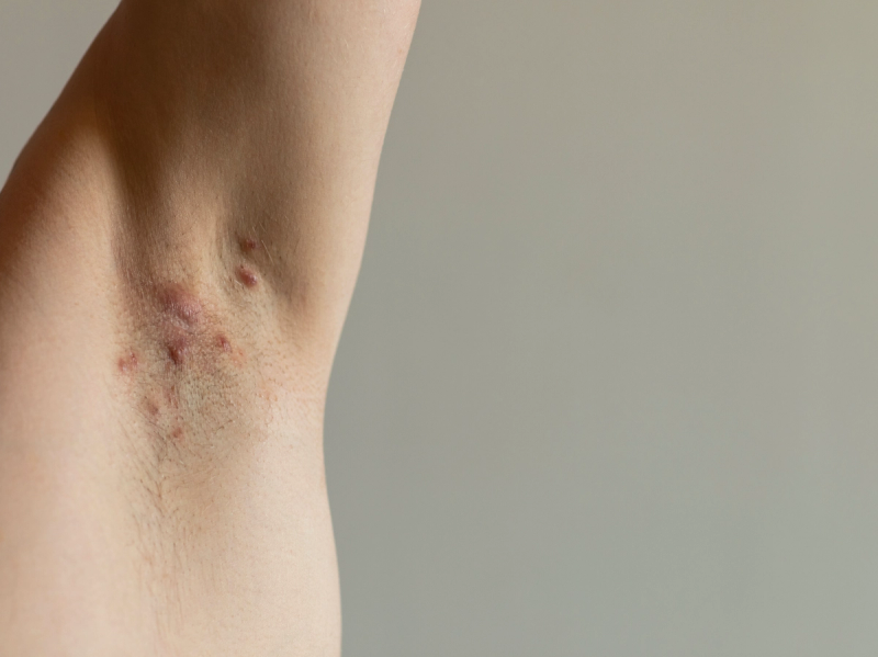 Hidradenitis Suppurativa