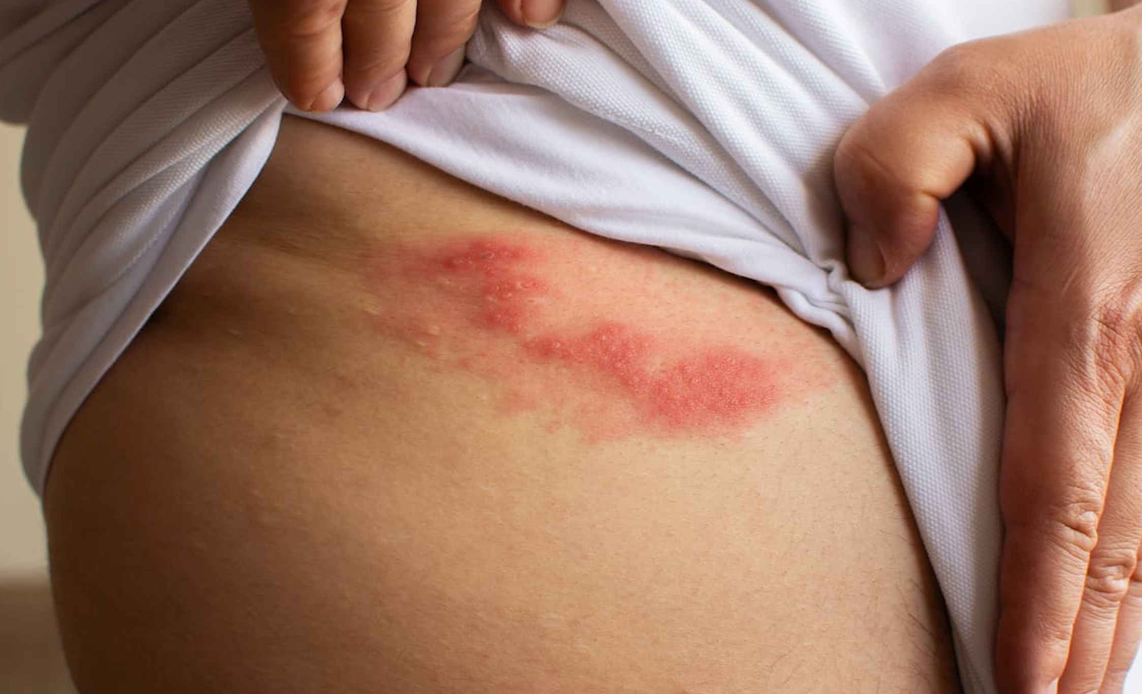 The More Severe the Eczema, the Higher the Shingles Risk, Research Shows 