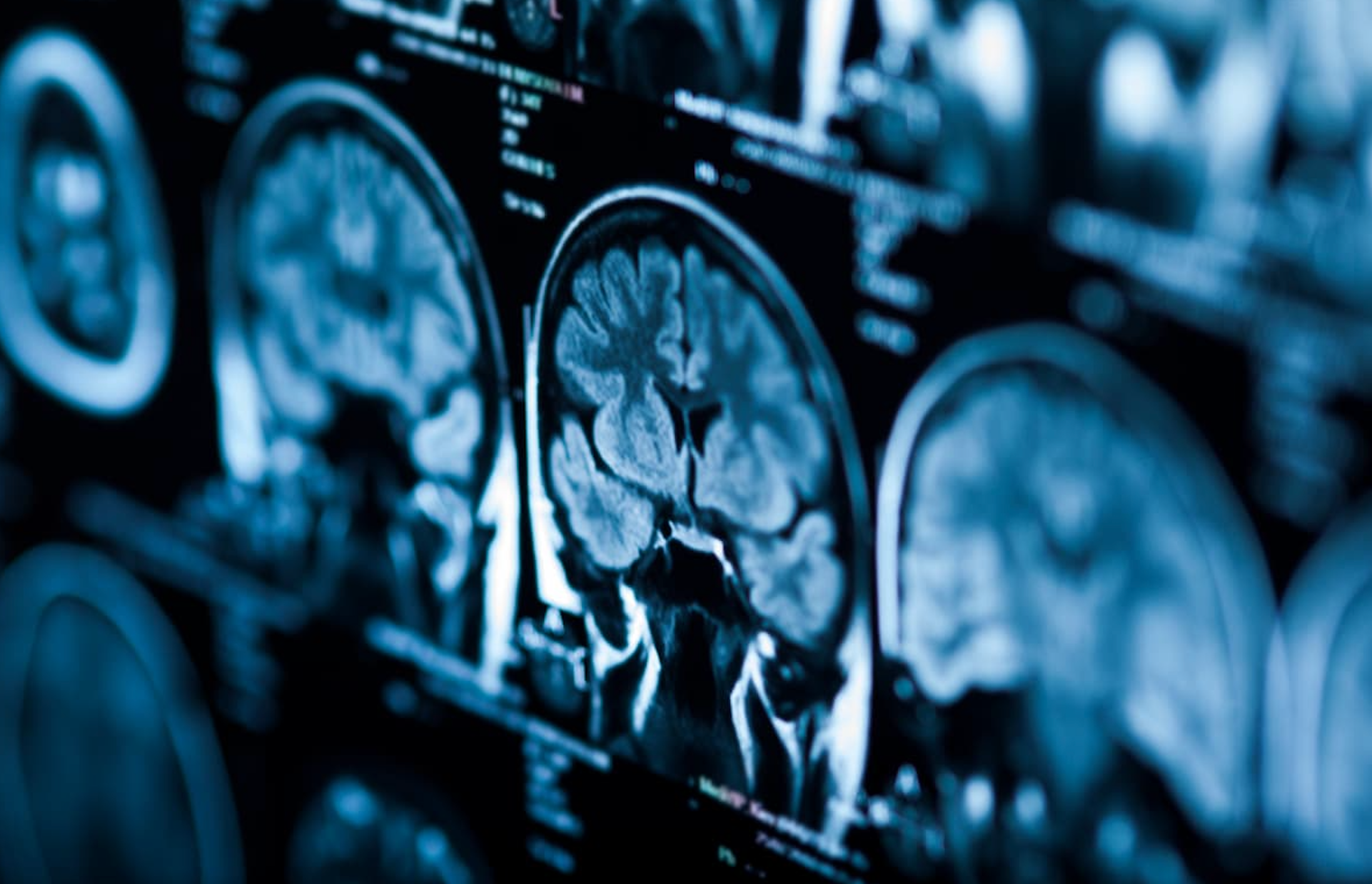 Massive Genetic Study Points to Brain Origins of Fibromyalgia
