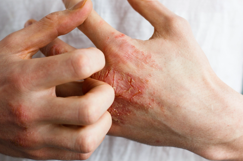Eczema Awareness Month Challenge: Test Your Skin Health IQ