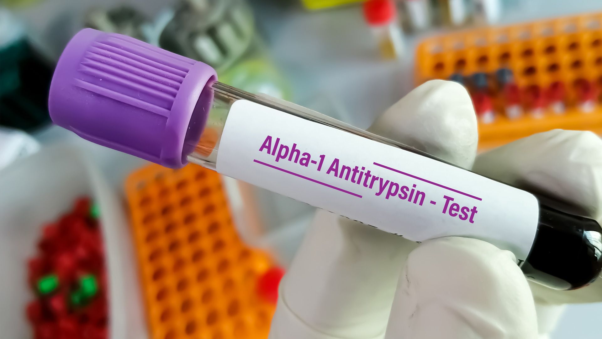 Alpha-1 Antitrypsin Deficiency