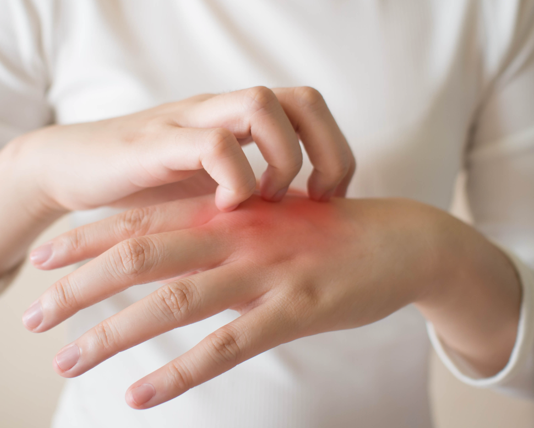 Relief and Hope for Painful Hand Eczema, With Linda Stein Gold, M.D.