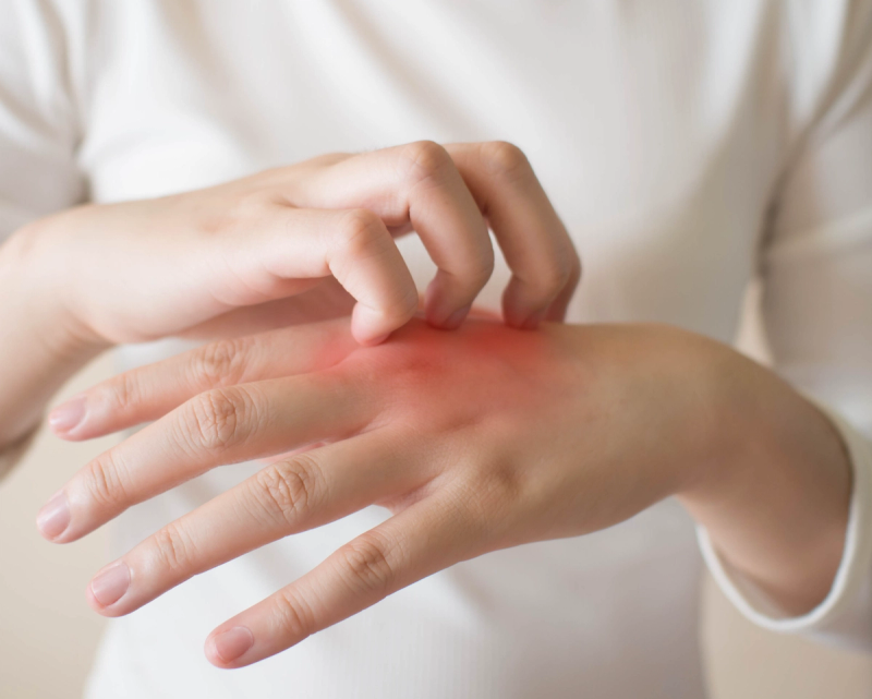 Relief and Hope for Painful Hand Eczema, With Linda Stein Gold, M.D.