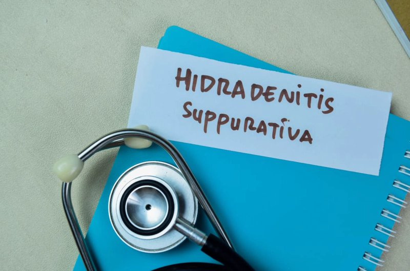 Understanding Hidradenitis Suppurativa: What You Need to Know