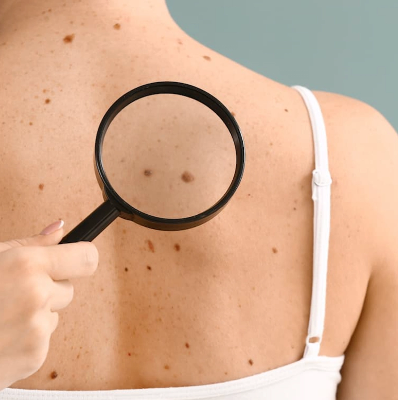 A Dermatologist’s Guide to Spotting Precancerous Skin Changes, with Elizabeth Hale, M.D.