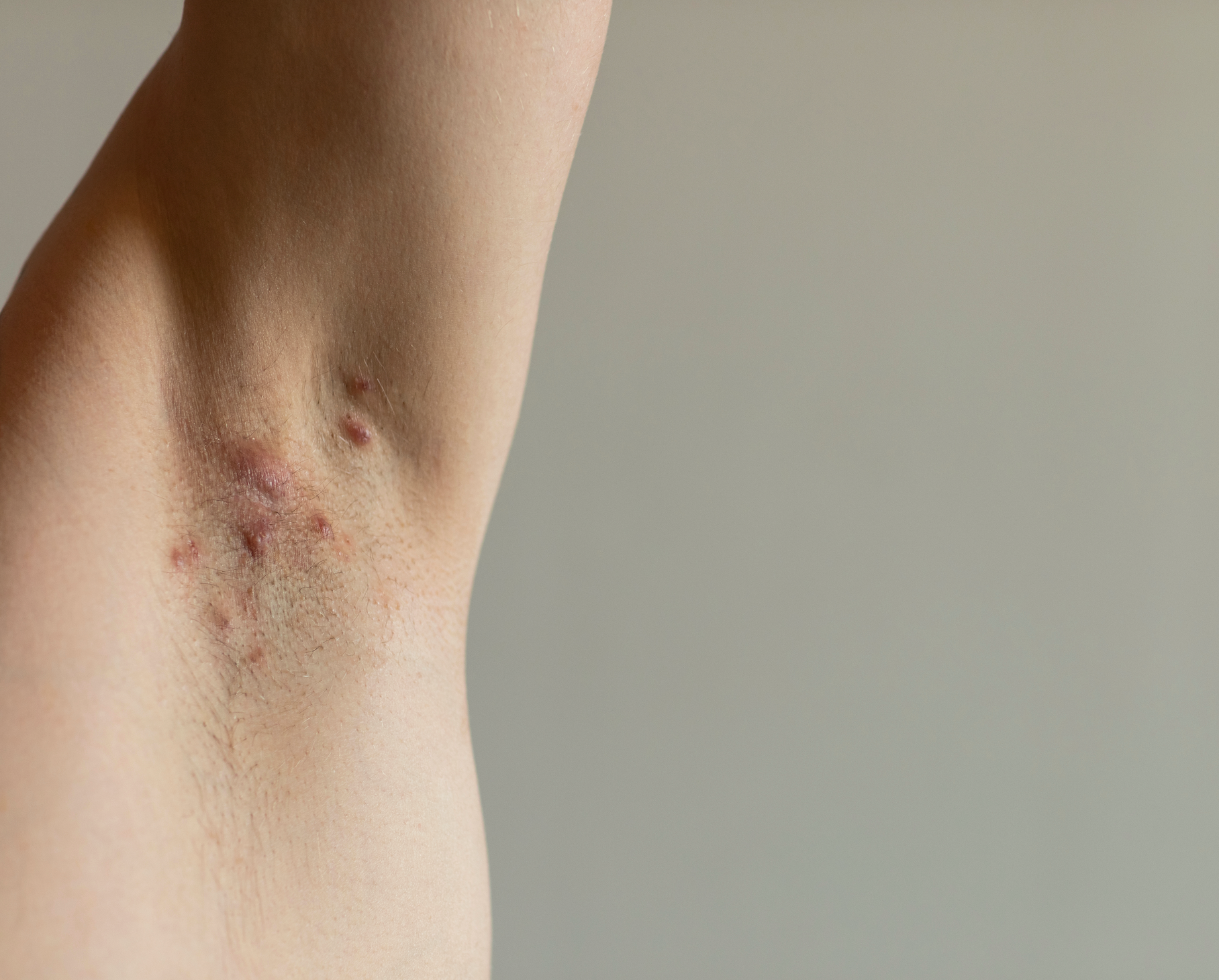 Why HS Is So Often Misdiagnosed, With Steven Daveluy, M.D.