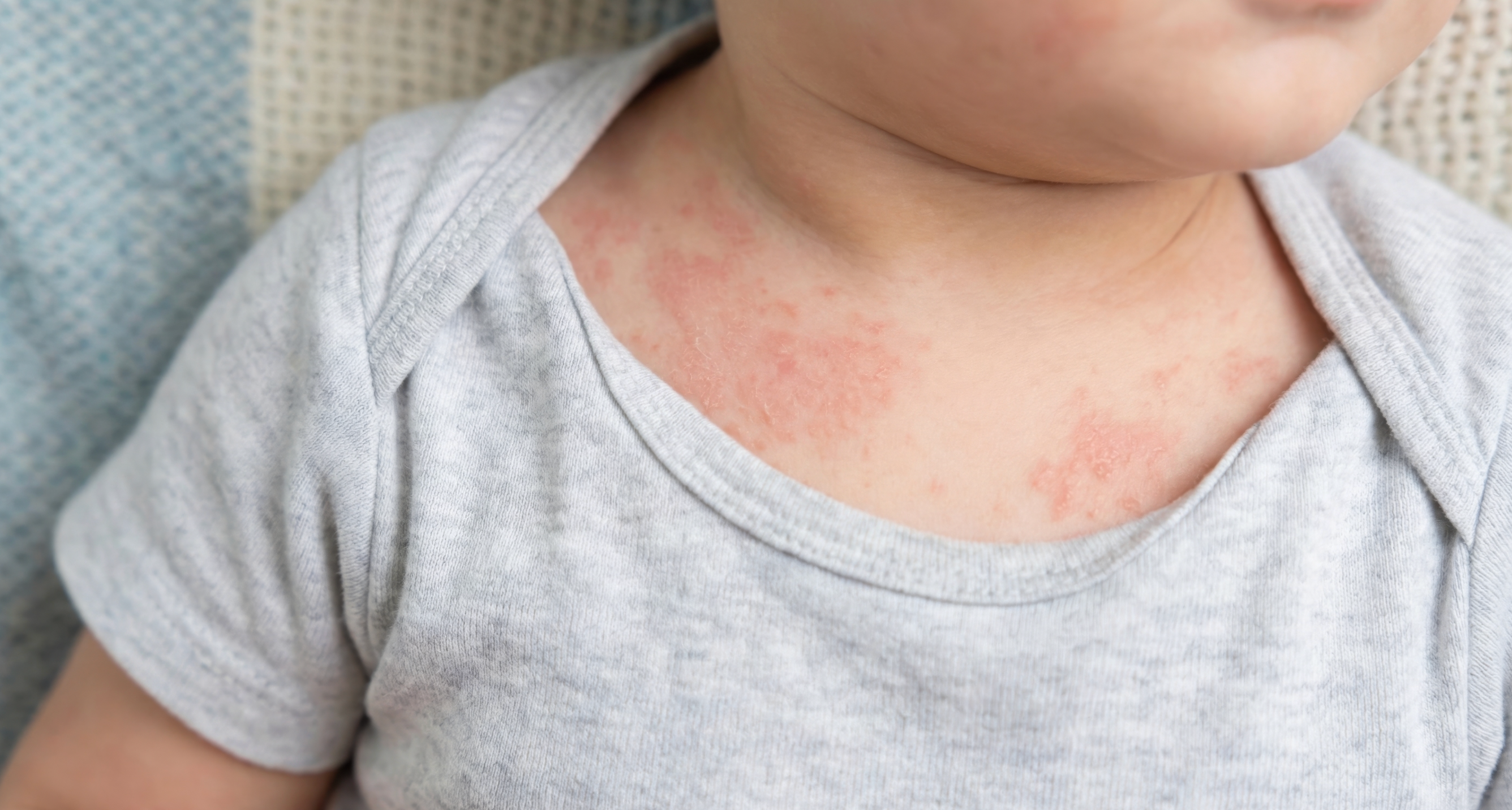 The Overlooked Symptoms of Anaphylaxis in Babies and Toddlers