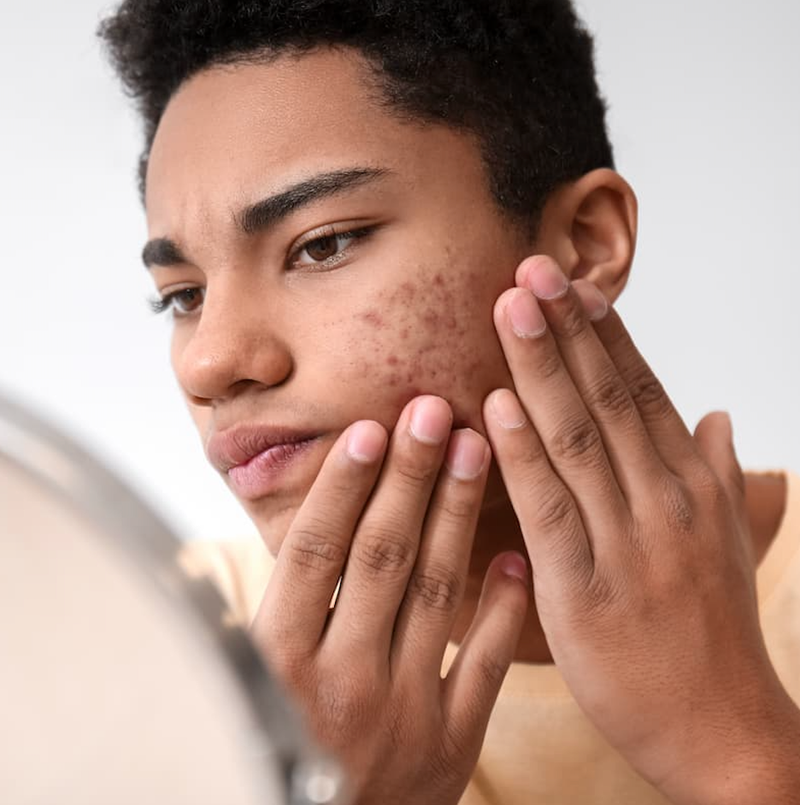 Patients with Acne at an Increased Risk of Gastrointestinal Issues 