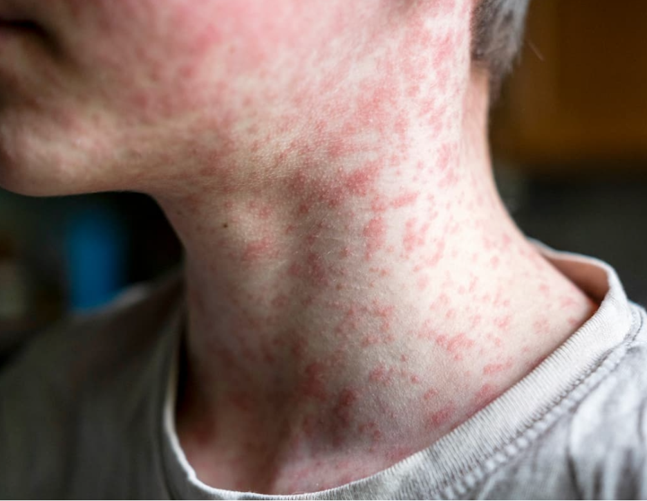 Measles Awareness Quiz: Separate Fact from Fiction